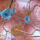 Dans le cerveau d'une personne atteinte de la maladie d'Alzheimer, les protéines bêta-amyloïdes s'agglutinent pour former des plaques (marron), tandis que des amas de protéines tau forment des enchevêtrements (bleu). On pense que ces structures perturbent le fonctionnement normal du cerveau. » Des scientifiques découvrent une forme inhabituelle de fer et de cuivre dans le cerveau des patients atteints de la maladie d'Alzheimer />Dans le cerveau d'une personne atteinte de la maladie d'Alzheimer, les protéines bêta-amyloïdes s'agglutinent pour former des plaques (marron), tandis que des amas de protéines tau forment des enchevêtrements (bleu). On pense que ces structures perturbent le fonctionnement normal du cerveau. Image : NIH Image Gallery/Wikimedia Commons</figure>
<p class=